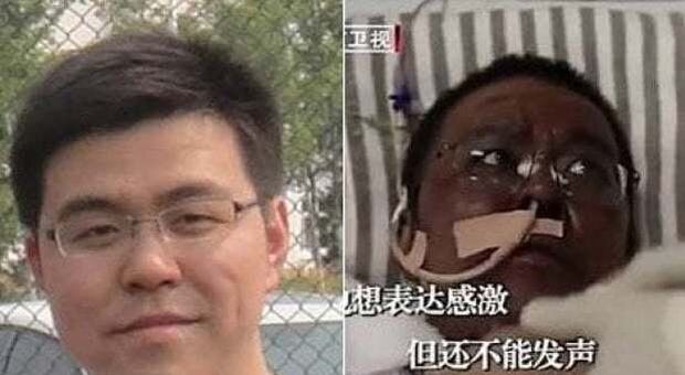 Virus, morto il medico di Wuhan che si risvegliò con la pelle nera: la sua foto fece il giro di mondo