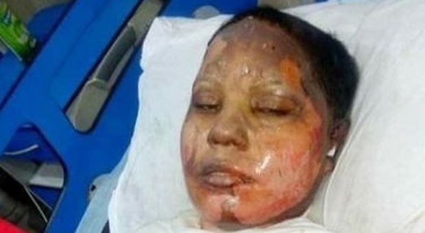 Non si converte all'Islam, ragazza cristiana di 24 anni bruciata viva dal fidanzato musulmano: è gravissima