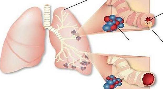 Malattie polmonari
