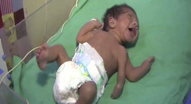 India, nasce con tre braccia: i dottori operano il bimbo e lo salvano