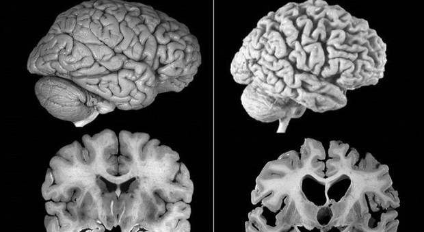 Alzheimer, si prevede anni prima se cambia il comportamento