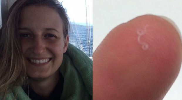 Usa, 28enne estrae 14 vermi da un occhio: è la prima volta che questo parassita portato dalle mosche viene riscontrato in un umano