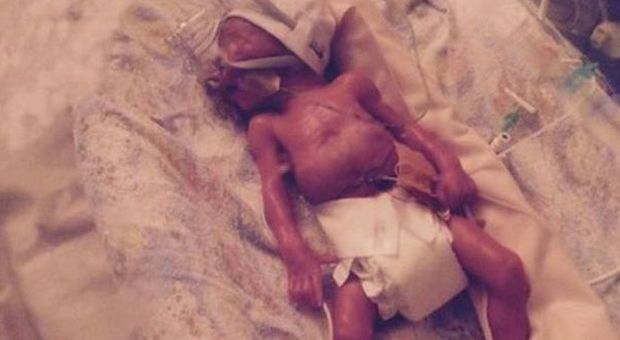 Il figlio nato prematuro sta morendo, i genitori postano la foto sul web: ecco perché -GUARDA
