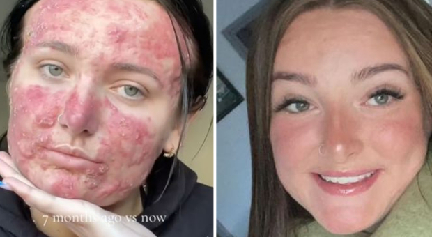 «Ero bullizzata per la mia acne, ora sono una beauty influencer»: ecco la cura miracolosa che le ha trasformato il viso