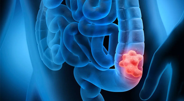 Tumore del colon, il nuovo studio: «Tra le cause anche i batteri intestinali come l'Escherichia coli»