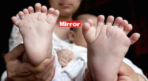 Il bimbo nasce con 31 dita tra mani e piedi (Mirror)