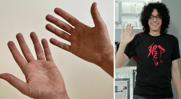 Giovanni Allevi, la battaglia con il mieloma: «Mi tremano le mani per i farmaci, non riesco a suonare»
