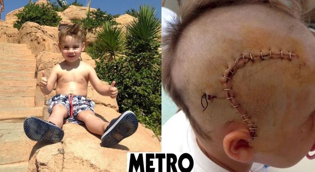 Bimbo di 3 anni schiacciato da un altoparlante: "Avrà danni permanenti al cervello"