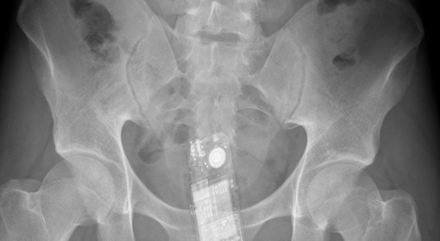 Quando il sesso sfugge di mano: le radiografie più assurde realizzate in ospedale