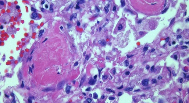 La polmonite da Covid più grave di quella da influenza: dura più a lungo e causa più danni