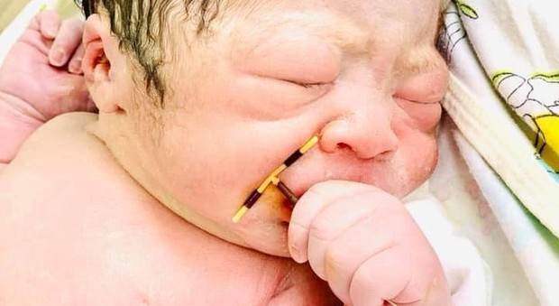 Il bambino nasce con la spirale intrauterina della mamma in mano, i medici: «Fatto rarissimo ma possibile»