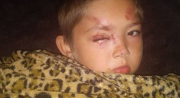 Bimbo di sei anni difende l'amico da una banda di bulli: loro gli rompono un braccio