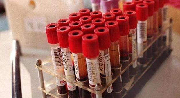 Anemia falciforme, uno studio promuove le trasfusioni di sangue