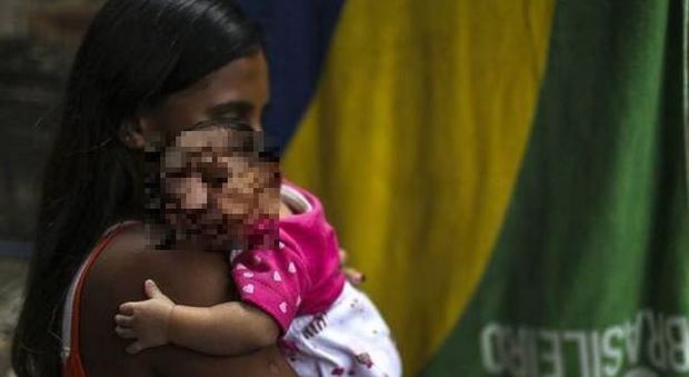 Brasile, microcefalia infantile. Gli effetti del virus Zika un anno dopo