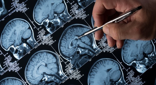Alzheimer, sperimentazione selvaggia sui malati: «Molecole dagli effetti ignoti». Scandalo in Francia
