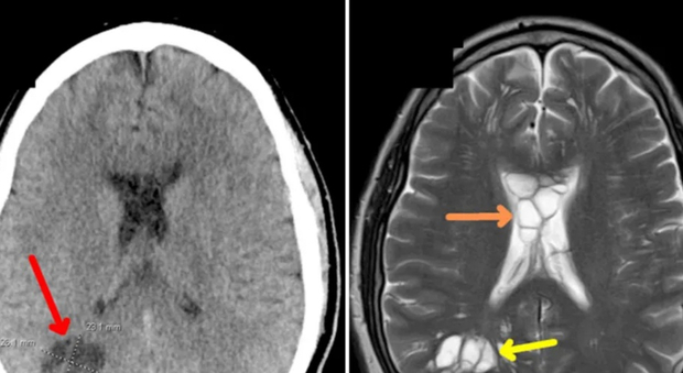 Un uomo di 52 anni scopre la causa della sua emicrania: la presenza di un verme nel cervello