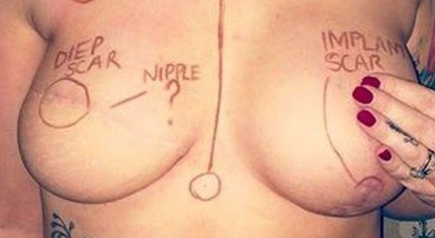 Pubblica su Fb le cicatrici della mastectomia: il web si commuove