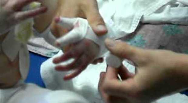 Bimba di 3 anni si rompe un dito: in ospedale le "steccano" quello sbagliato