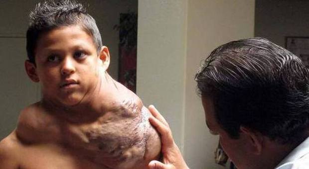 Ha un cancro al collo grande come un pallone da calcio, operato bimbo di 11 anni
