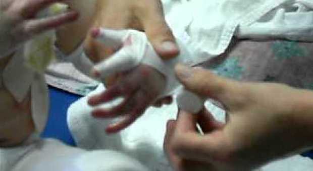 Bimba di 3 anni si rompe un dito Ma le steccano quello sbagliato