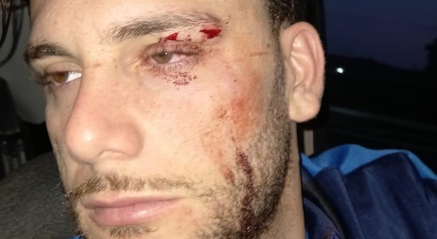 Vincenzo Carfagno, attaccante dell’Atletico San Gregorio, dopo l’aggressione subita al termine della partita ha rimediato 5 punti di sutura