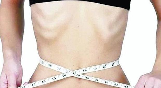 Codice Lilla, negli ospedali non c'è traccia: anoressici ignorati al pronto soccorso