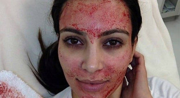 Iniezioni di sangue sul viso: ecco il nuovo rimedio di bellezza che garantisce i risultati