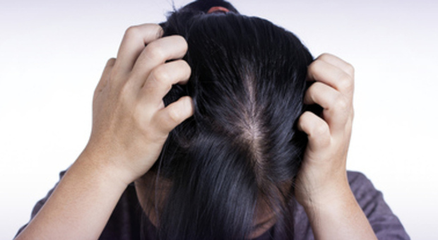 Alopecia nelle donne, aumentano i casi: ne soffre il 13% della popolazione femminile