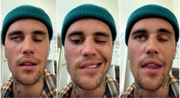 Justin Bieber, la malattia di Lyme e la sindrome di Ramsay Hunt: «Ho metà del viso paralizzato»