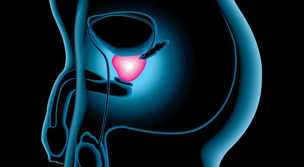 Cancro alla prostata, tra le cause anche variazioni genetiche: in arrivo un test per scoprirlo