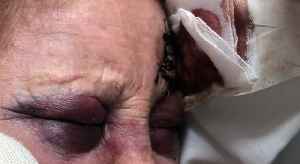 Anziana massacrata da due scippatori a Mergellina: «Io, vittima dei barbari»
