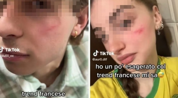 Cicatrice francese sul volto degli adolescenti, il trend di TikTok allarma le scuole: «È autolesionismo»