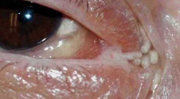 Una mosca depone le uova nel suo occhio, i medici le rimuovono 120 vermi dagli occhi