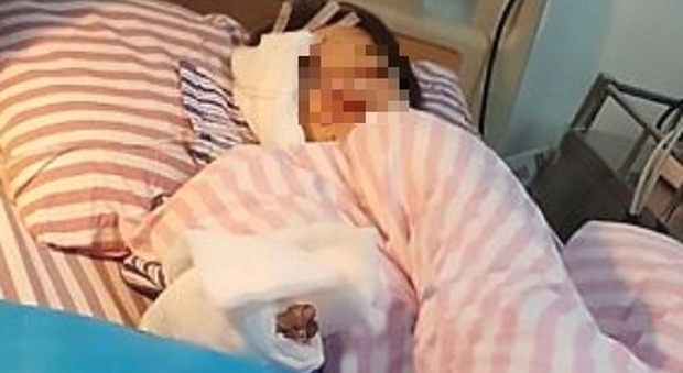 Esplode cellulare in carica: 12enne perde un dito e un occhio