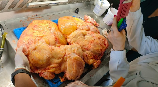 Tumore, operazione record all'ospedale di Pagani: asportata massa da 10 chili nell'addome di una ragazza di 28 anni