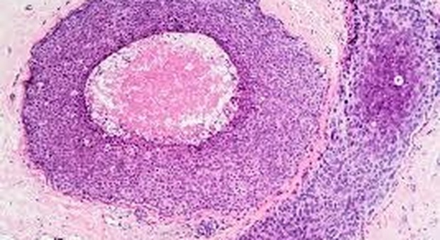 Tumore al seno, proteina gli fa da scudo e ostacola la progressione della malattia