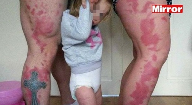 Genitori si tatuano la voglia gigante della figlioletta sulle gambe. ​"È per farla sentire speciale"