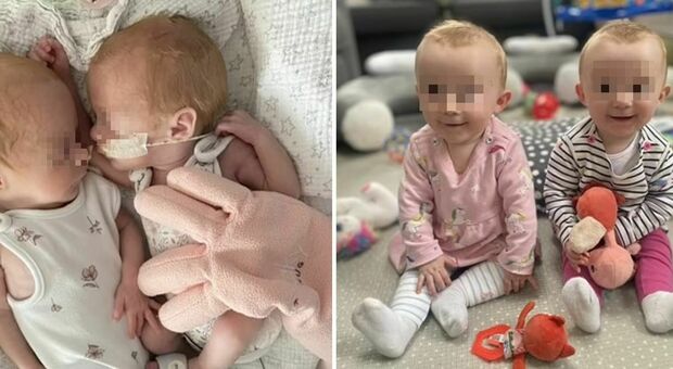 Il miracolo delle gemelline nate 10 settimane prima: «I medici le davano per spacciate, pesavano 900 grammi»