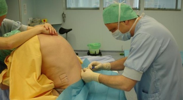 Usa, ha un ago nella schiena da 14 anni: era stato usato per l'epidurale durante il parto