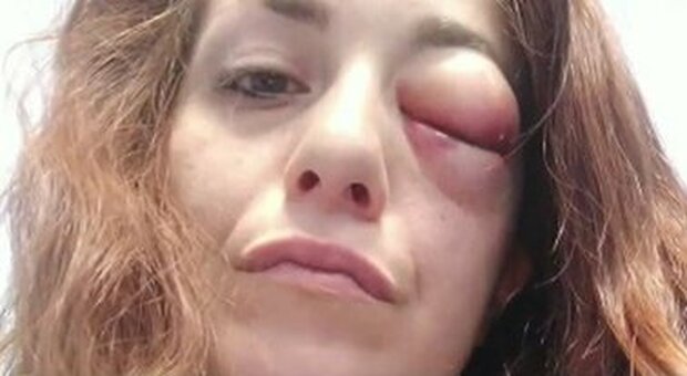 Giuliana Danzè massacrata di botte dall'ex: «Ci metto la faccia, questo non è amore»