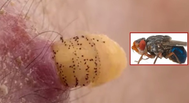 Scopre una larva nel braccio: invece di estrarla la lascia lì per studiarla