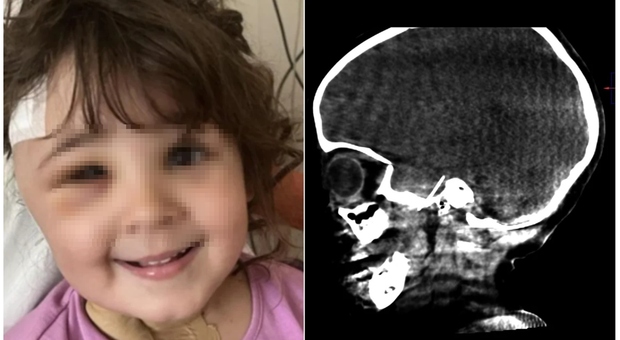 Bambina di 4 anni dal dentista per una carie, l'ago dell'anestesia sparisce in bocca e arriva al cervello: Sara salvata con un'operazione d'urgenza