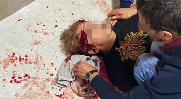Pestata a sangue dai vicini nel Napoletano: aveva “osato” protestare per lavori abusivi nel palazzo