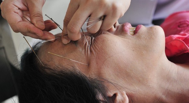 L'agopuntura funziona contro la paura del dentista
