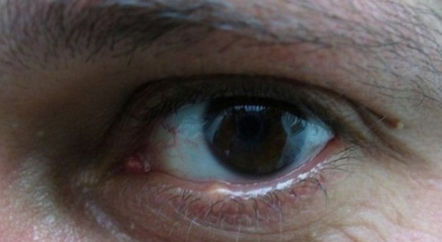 Errore nella preparazione del farmaco: cinque pazienti rischiano la vista