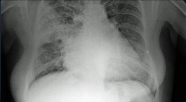 Covid, come si sviluppa la polmonite bilaterale? Il ruolo delle particelle di grasso killer