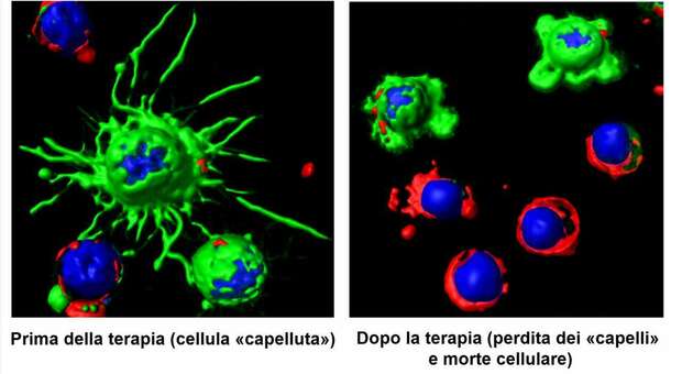 Leucemia a cellule capellute, scoperta a Perugia terapia di precisione