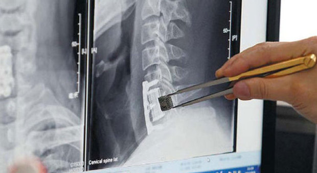 Prima operazione con vertebra stampata in 3D: "12enne tornerà a camminare"