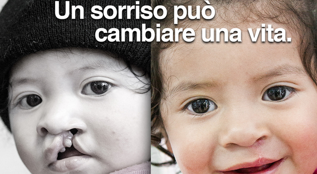 Operation Smile, ogni tre minuti nasce un bimbo con una malformazione al volto: a Roma weekend di visite gratuite