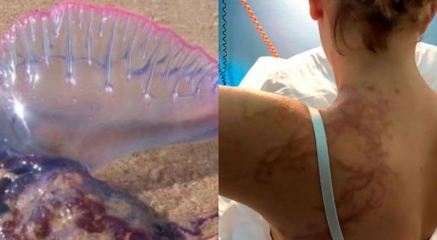 La medusa Man O'War attacca sette bagnanti: feriti e ricoverati in ospedale, terrore in spiaggia